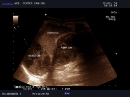 Ultrazvok ledvic - hematom ob vranici
